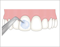 フッ素塗布の図