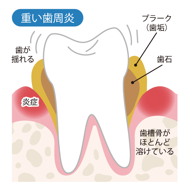 重い歯周炎 かわい歯科クリニック 新着情報